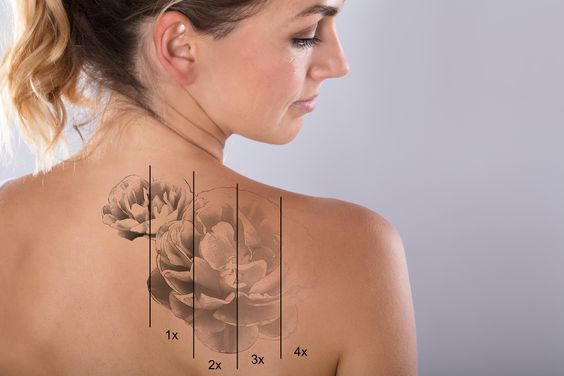 Surprising Truths About PicoSure Tattoo Removal That Will Amaze You