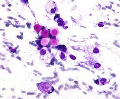 Cryptococcosis Therapeutics Market 2032 Report Details Overview, Growth Forecast, Demand and Development Research Report to 2032