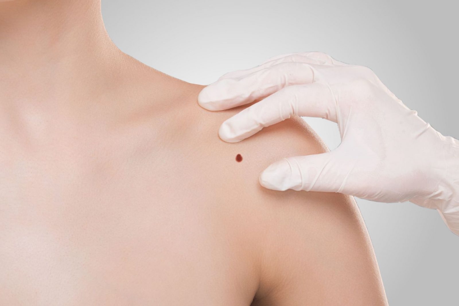 From Consultation to Aftercare: A Complete Mole Removal Journey