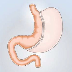 How Gastric Sleeve Surgery Can Transform Your Life