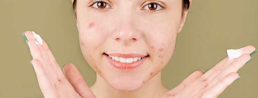 How to Conquer Hormonal Acne with the Right Treatments