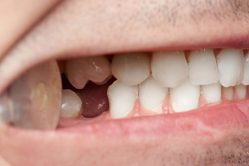 Effective Overlapping Teeth Treatment Options
