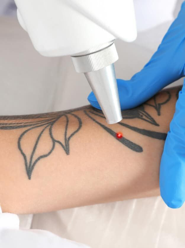 Can Laser Tattoo Removal Be Done on All Tattoos