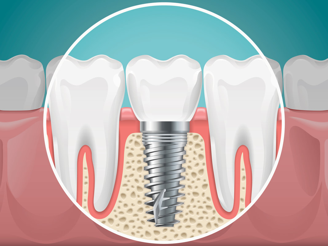 Osseointegration Implants Market 2029: Untapped Opportunities and Growth Strategies Revealed