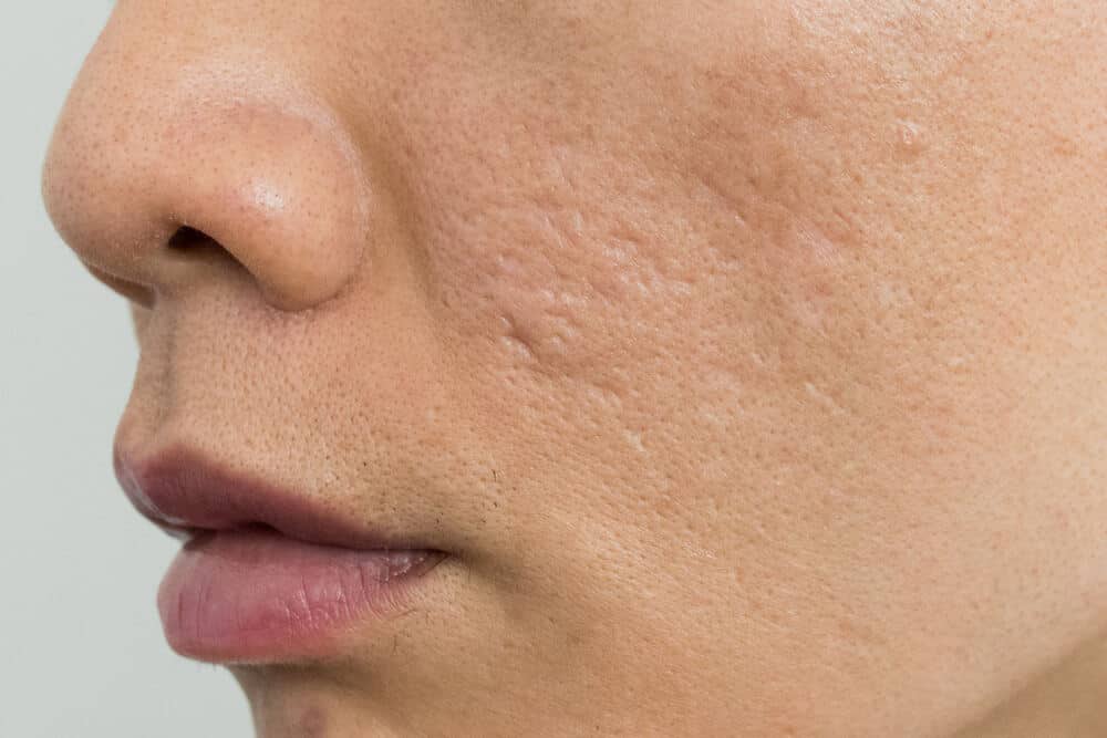 Get Rid of Scars Fast with Laser Scar Removal Treatments