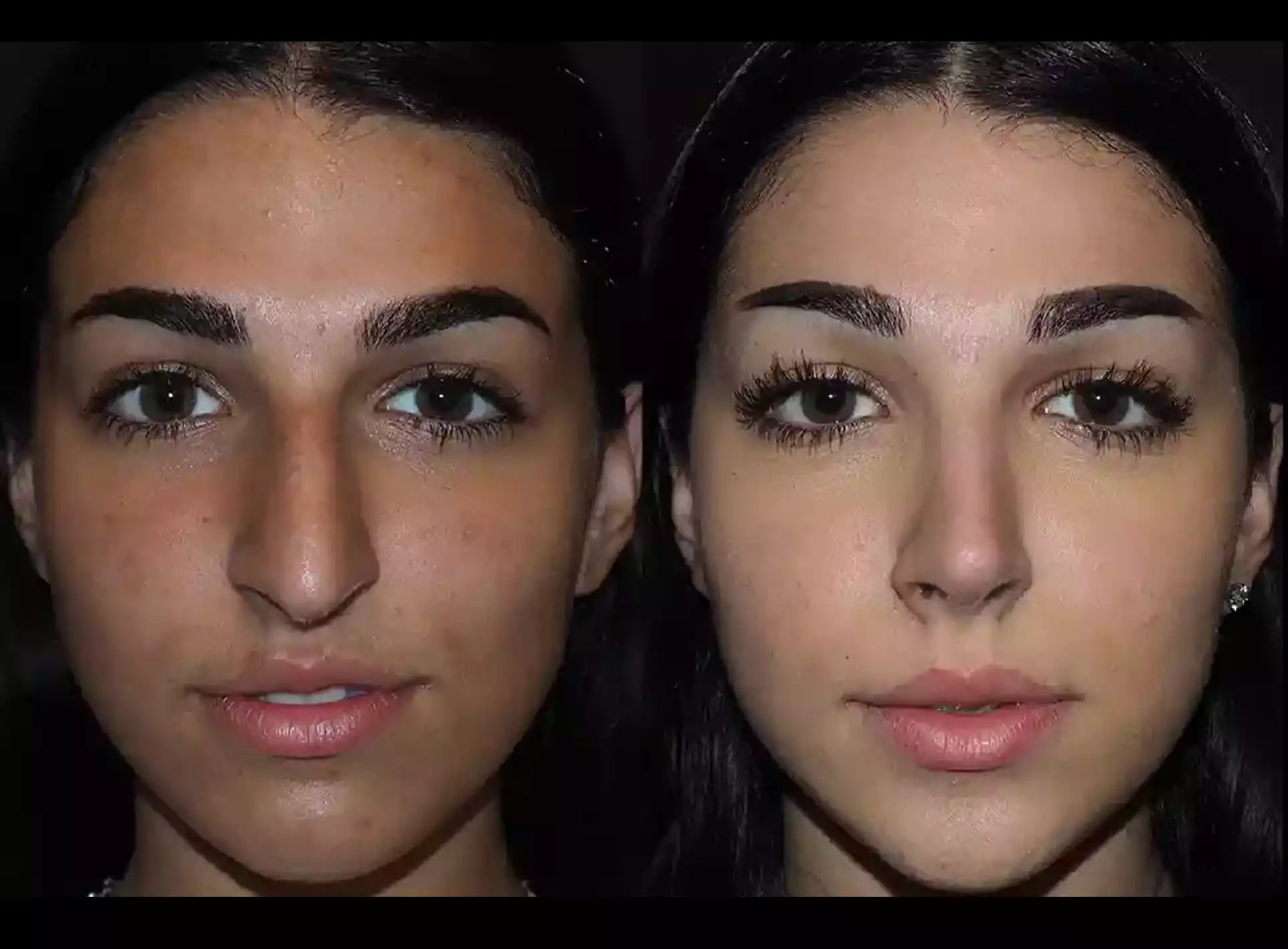 What Happens During a Rhinoplasty Consultation A Step-by-Step Guide