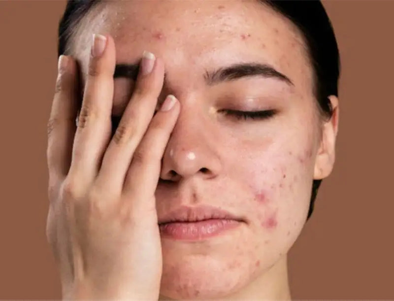 Freckles Are Forever, Blemishes Are Fleeting