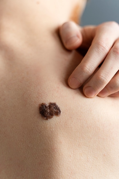 Can warts removal a permanent procedure