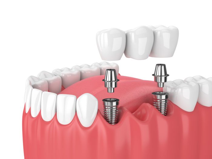 How to Spot Complications After Dental Implant Surgery