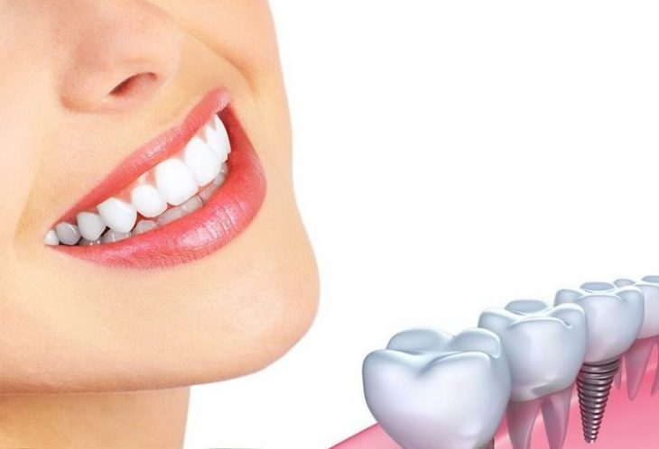 The Benefits of Dental Implants: A Comprehensive Guide
