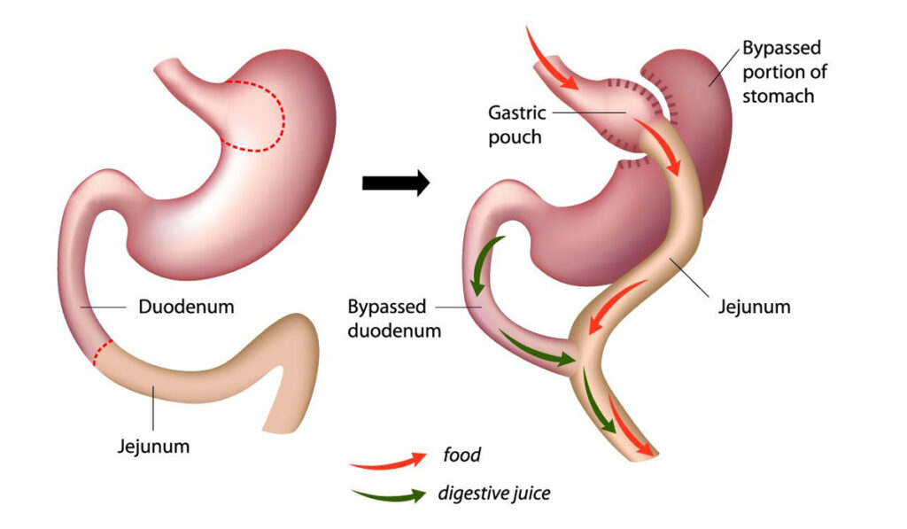 Mini Gastric Bypass: A Complete Overview