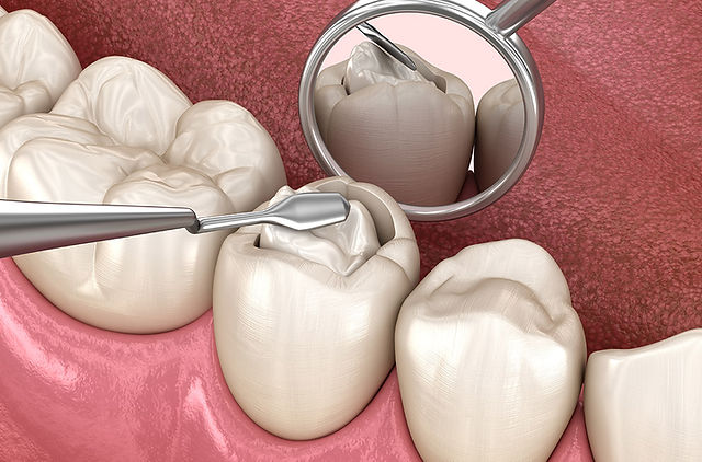 Everything You Need to Know About Dental Fillings