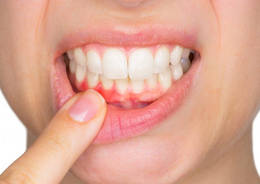 Effective Solutions for Bleeding Gums