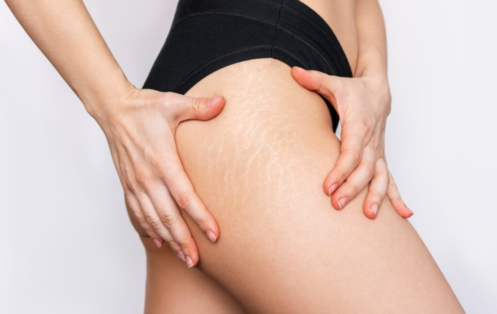 Laser Stretch Mark Removal: Everything You Need to Know