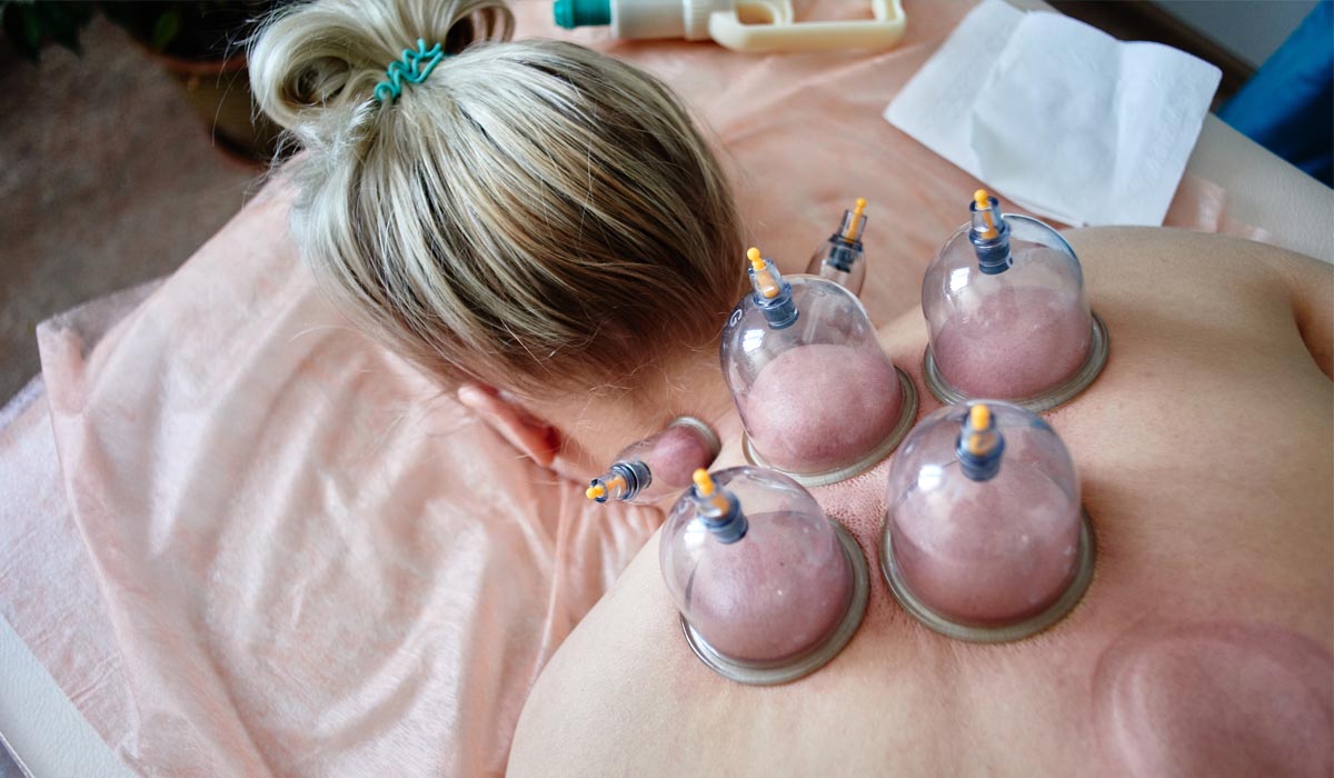 Hijama Cupping Therapy for Skin and Beauty: A Natural Solution
