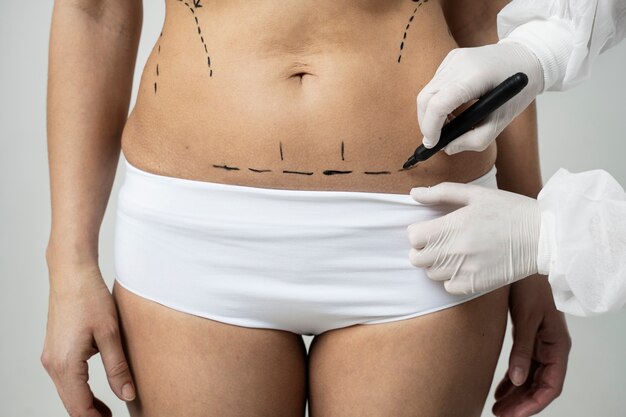 What Are the Benefits of Liposuction for You?
