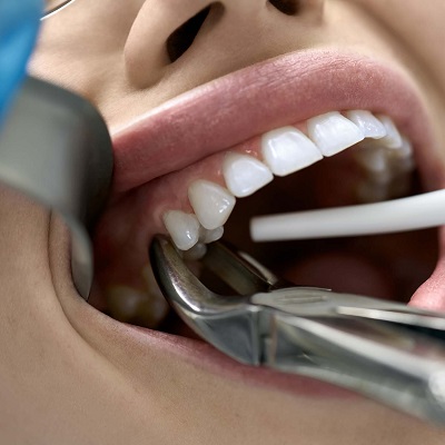 Can Dental Extractions Help with Tooth Decay in Dubai?