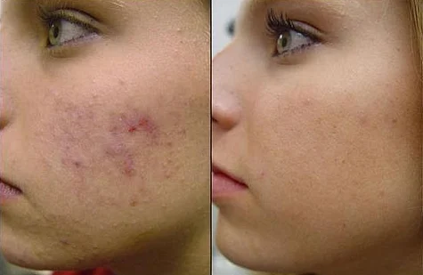 Frequently Asked Questions About Laser Scar Removal in Dubai