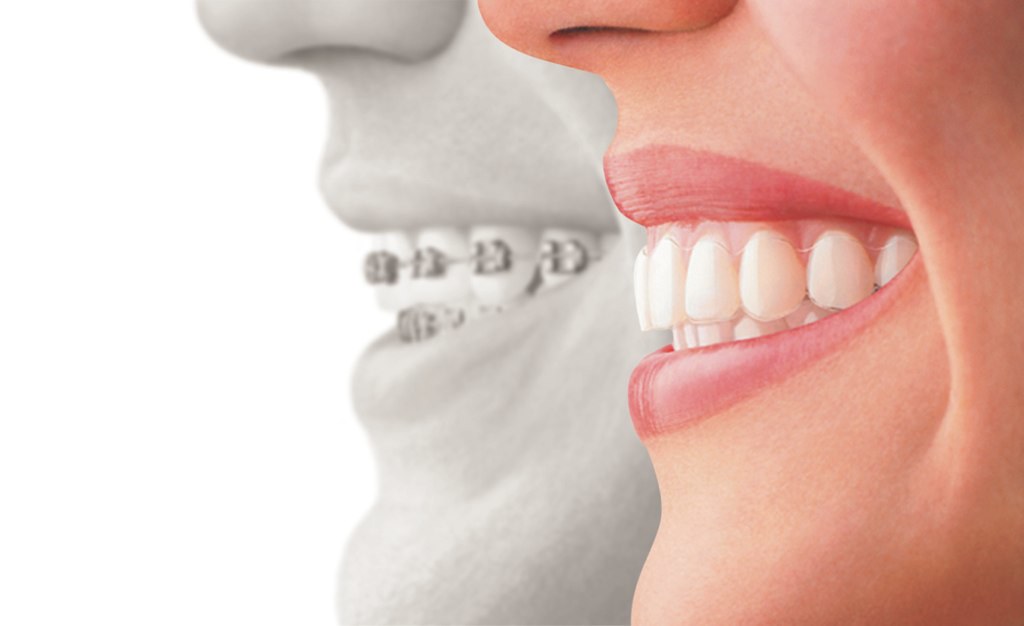 Clear Aligners in East Hanover: Your Guide to a Straighter Smile