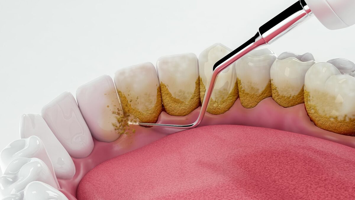 Why Teeth Polishing & Scaling Are Essential for Healthy Teeth