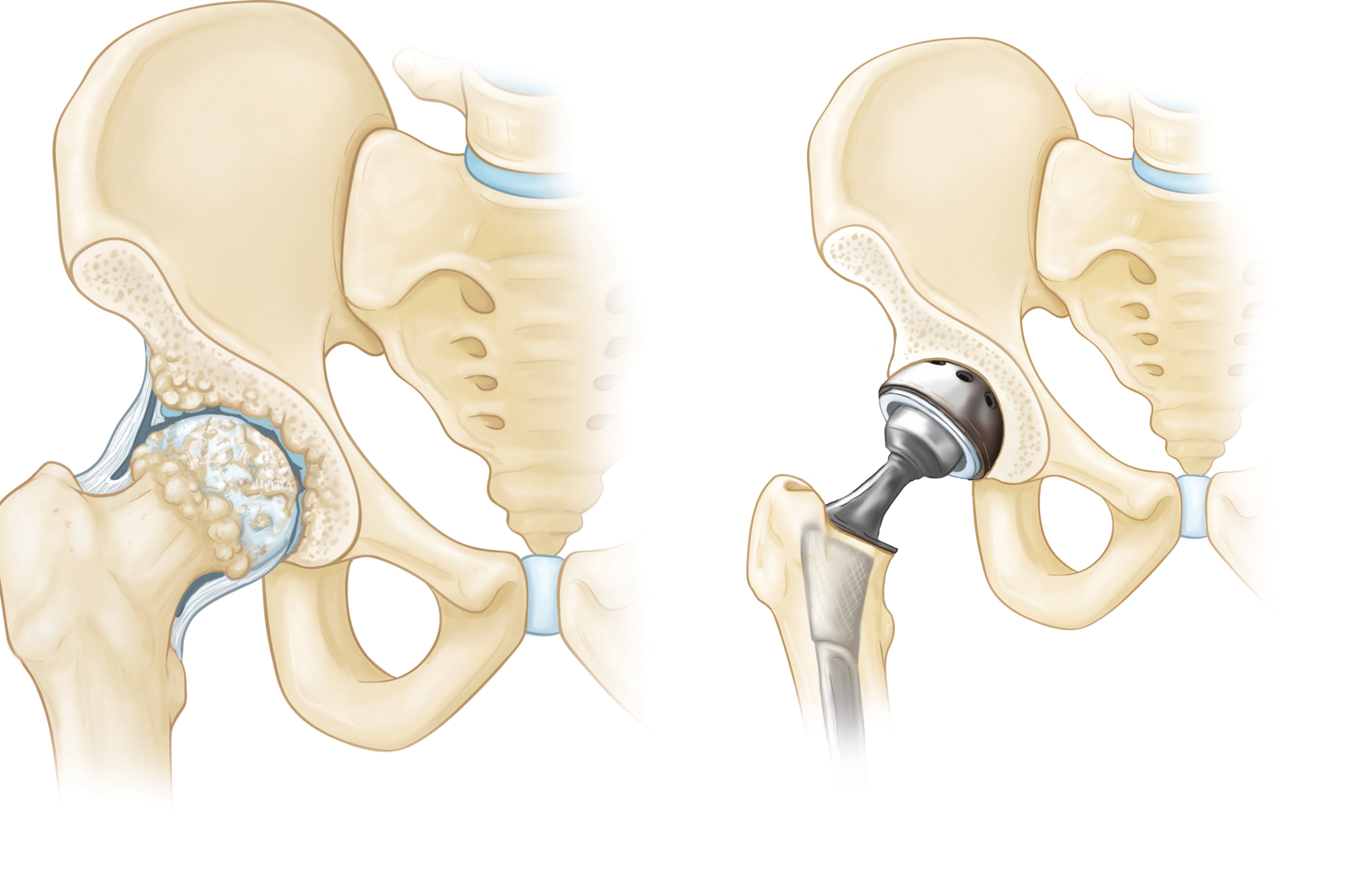 Artificial Hip and Knee Joints Market 2029: Untapped Opportunities and Growth Strategies Revealed