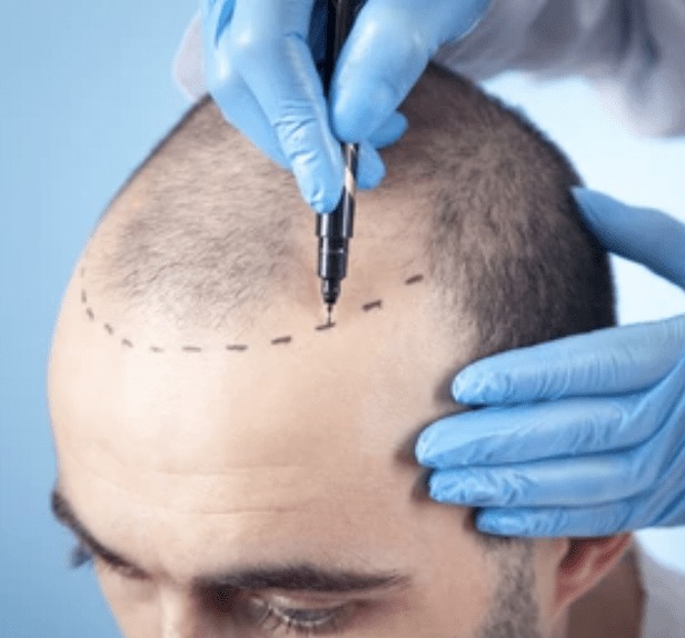 Is Hair Transplantation Right for You? A Complete Guide