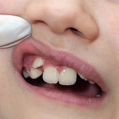 Why Dubai Is a Top Destination for Overlapping Teeth Treatment