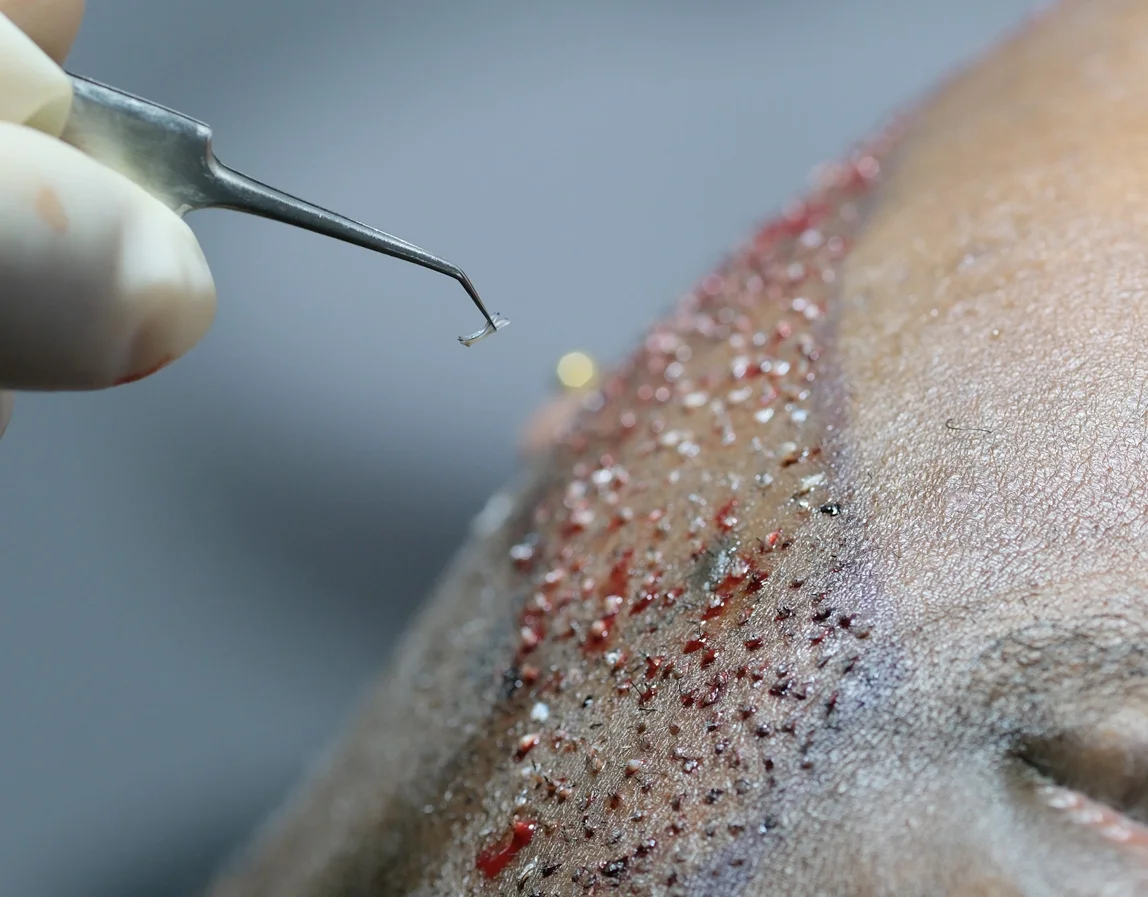 Perfect Your Beard Shape with a Hair Transplant