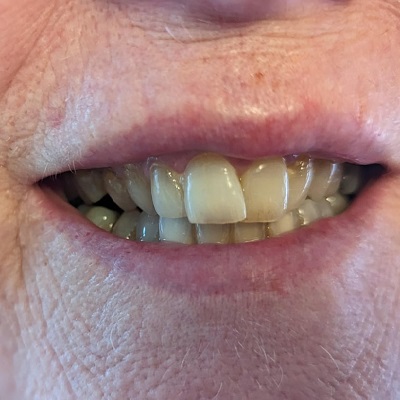 Correcting Overlapping Teeth: Is Braces Treatment Right for You in Dubai?
