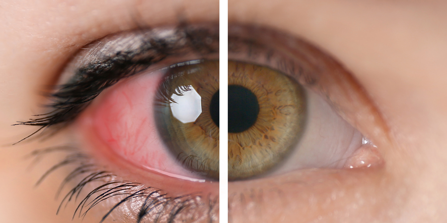 Anterior Uveitis Treatment Market 2029: Surprising Facts and Future Projections Exposed