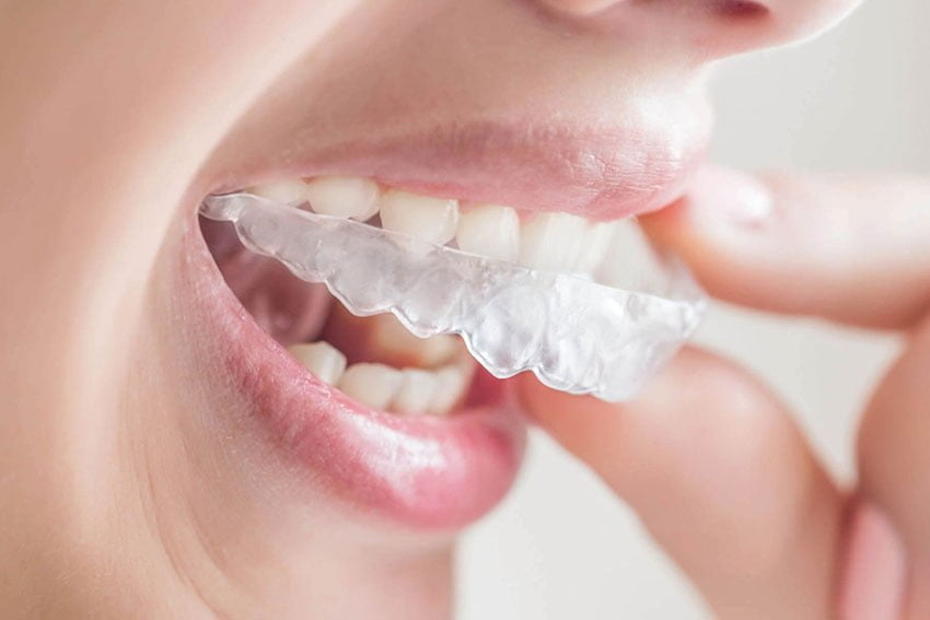 Step-by-Step Guide to Getting Aligners in Dubai
