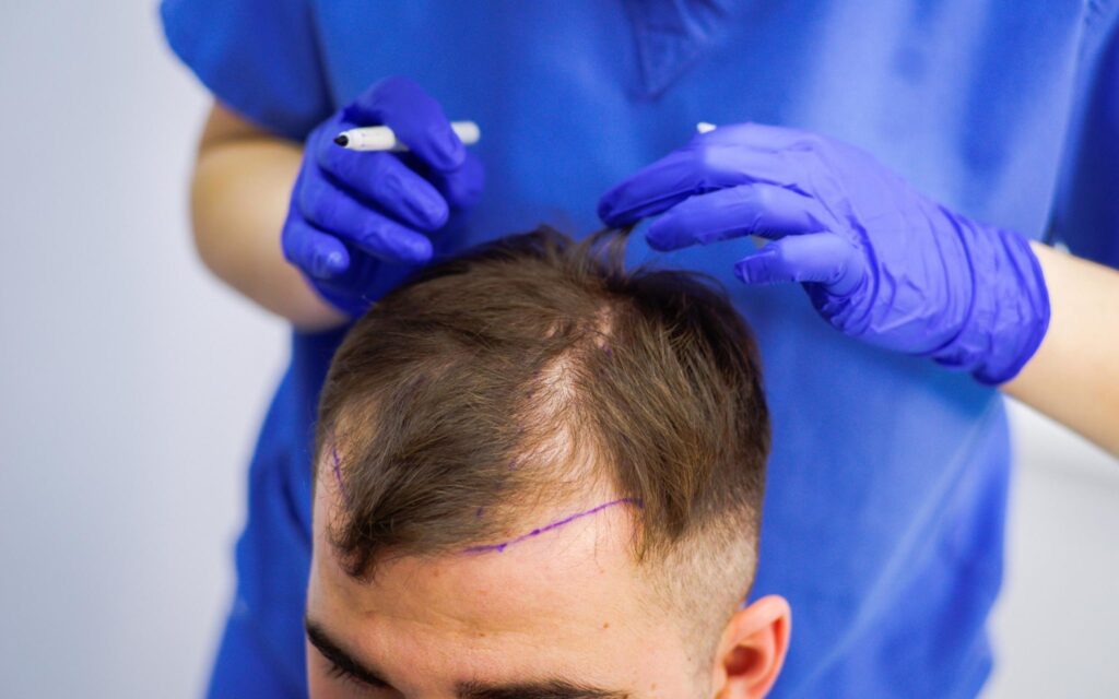 The Role of PRP Therapy in Hair Transplants in Riyadh