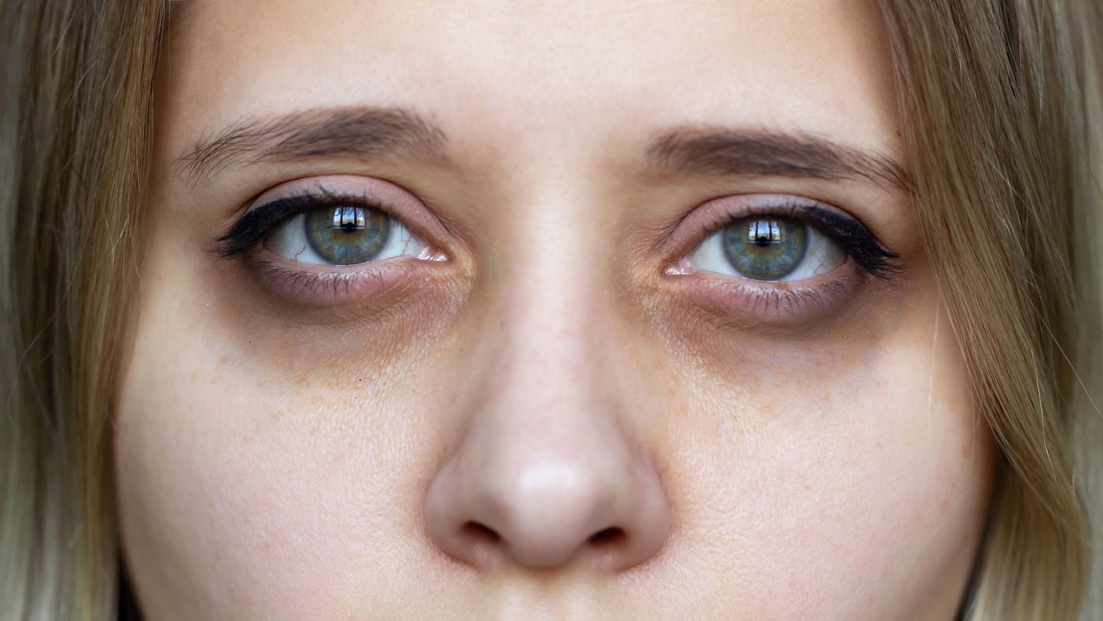 Non-Surgical Dark Circles Treatments in Riyadh