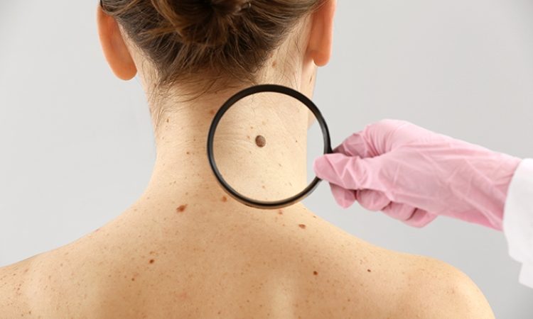 What Are the Latest Innovations in Mole Removal?
