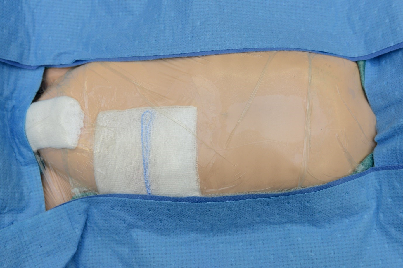 Stoma/Ostomy Care Market Size, Share, Growth, Challenges and Global Forecast 2024-2032