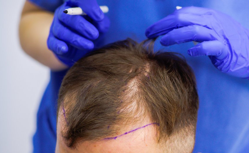 Expert recommendations for GFC hair transplant in Riyadh