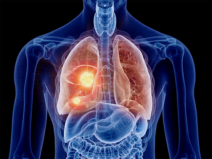 Lung Cancer Surgery Market: Size, Share, and In-Depth Competitive Analysis Toward 2029
