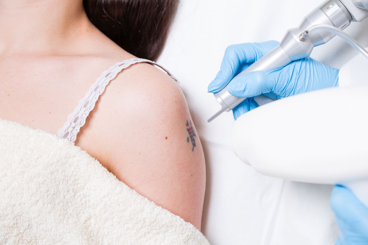 The Best Times to Schedule Your Laser Tattoo Removal in Riyadh