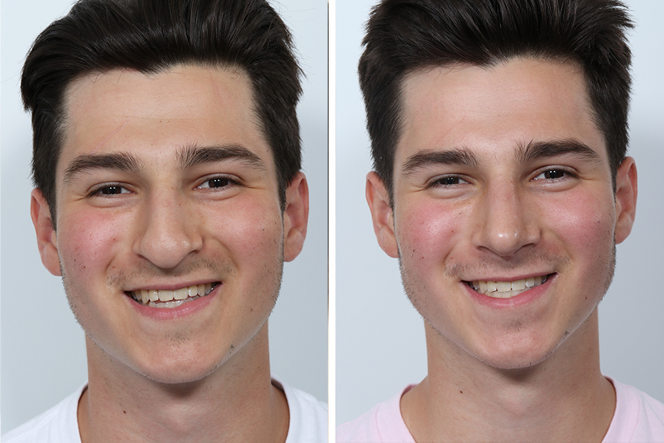 Bulbous Nose Job: What to Expect and How It Enhances Facial Harmony