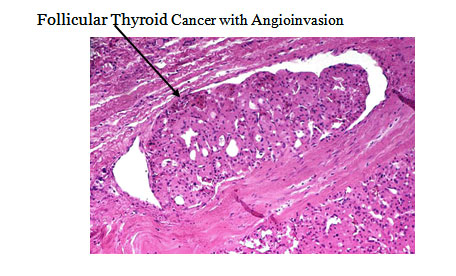 Follicular Thyroid Cancer Drug Market: Size, Share, and In-Depth Competitive Analysis Toward 2029