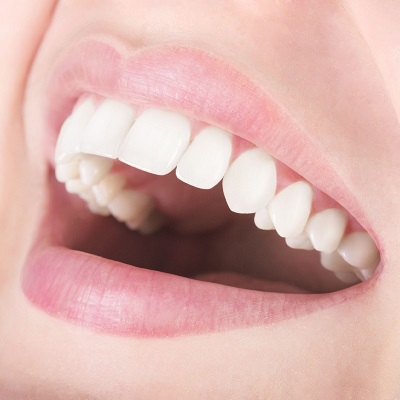 Alternative Treatments for Overlapping Teeth Beyond Braces