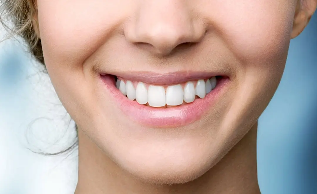 Teeth Whitening in Dubai: What You Need to Know Before You Go