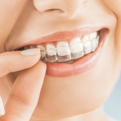 Why Overlapping Teeth Can Lead to Gum Disease
