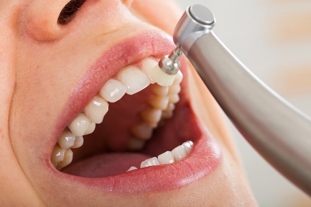 Teeth Whitening and Your Oral Health: What You Need to Know