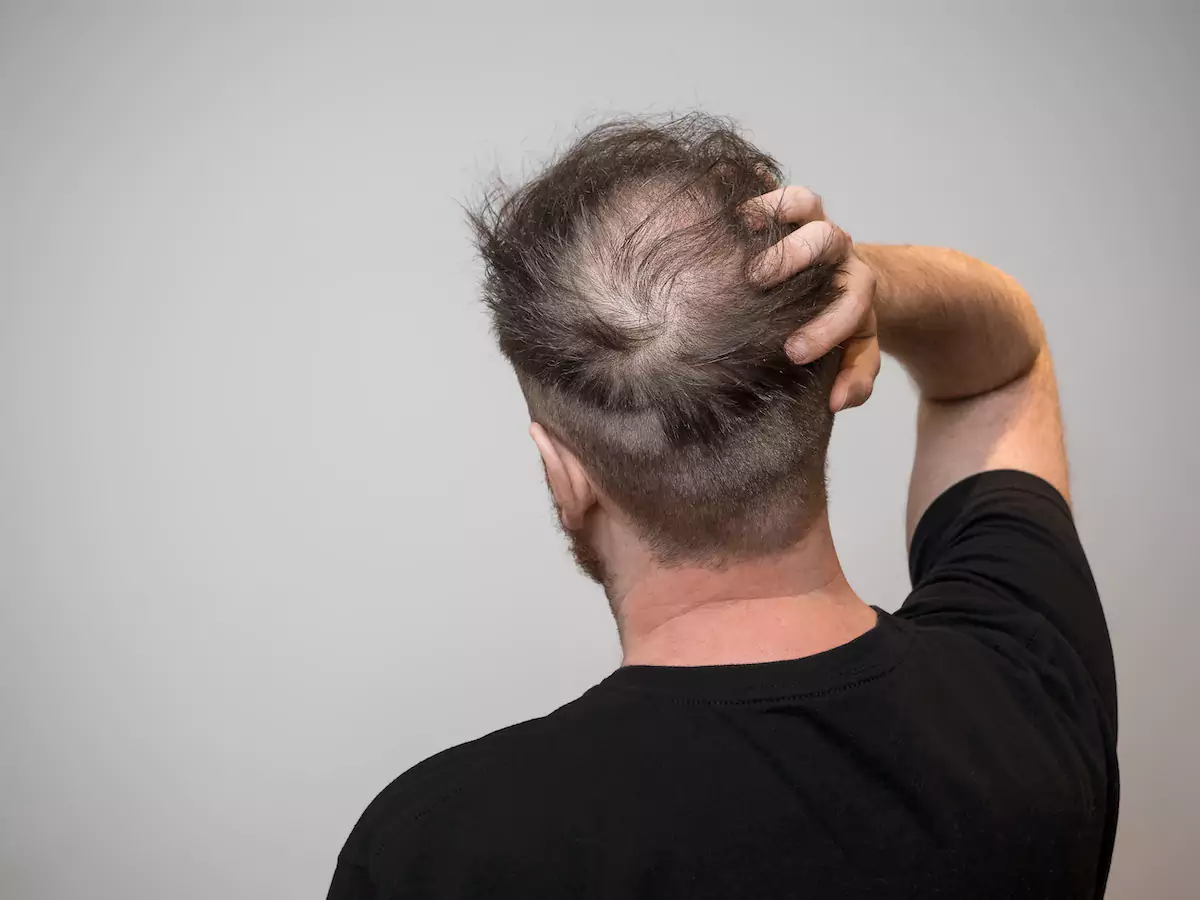 Restore Your Crown Area’s Fullness with a Hair Transplant