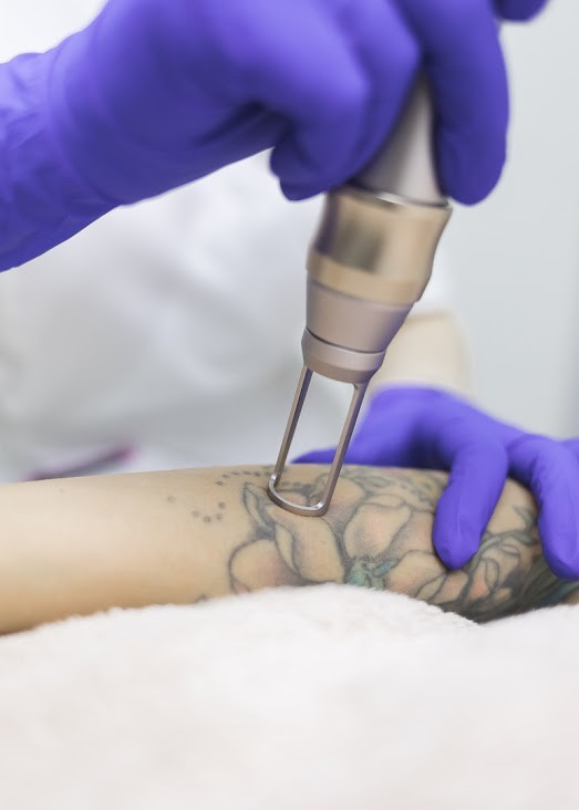 How Advances in Technology Are Making Tattoo Removal Easier