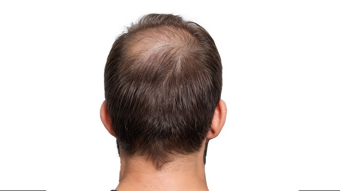 How Long Do Crown Hair Transplant Results Last?