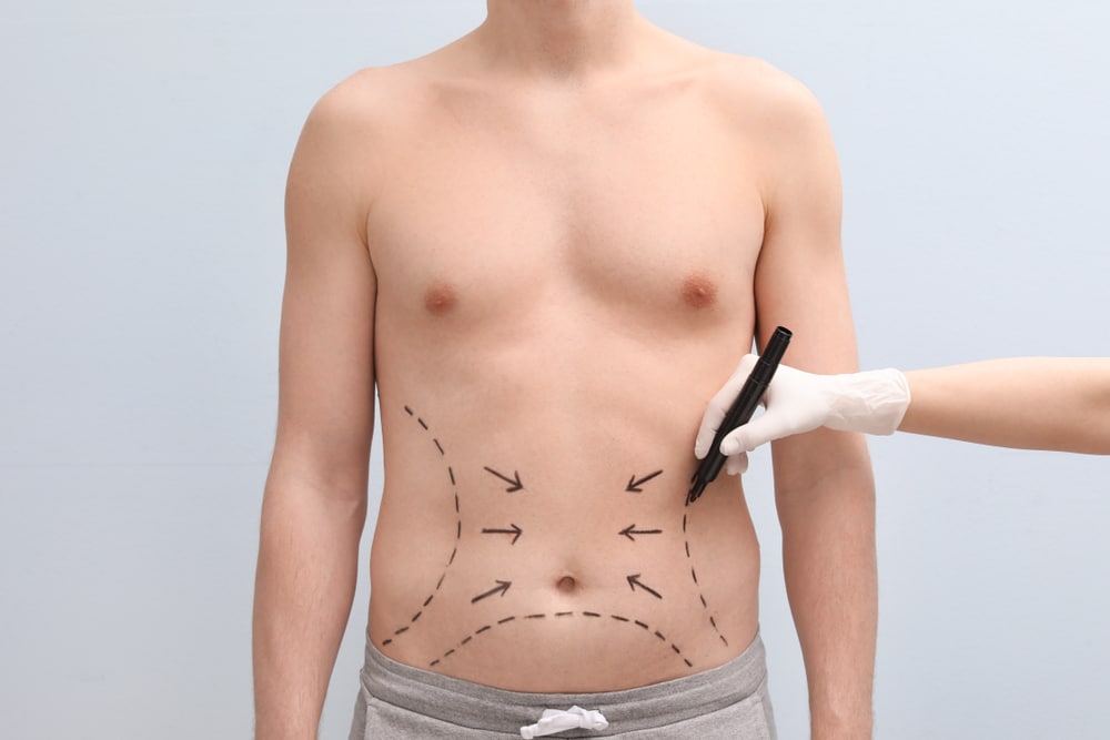 Riyadh’s Best VASER Liposuction Clinics for Targeted Fat Removal