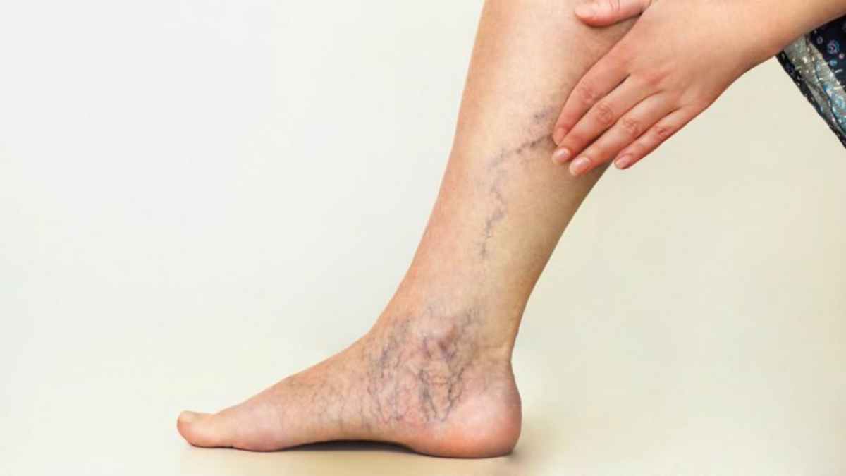 Choosing the best clinic for varicose veins treatment in Riyadh