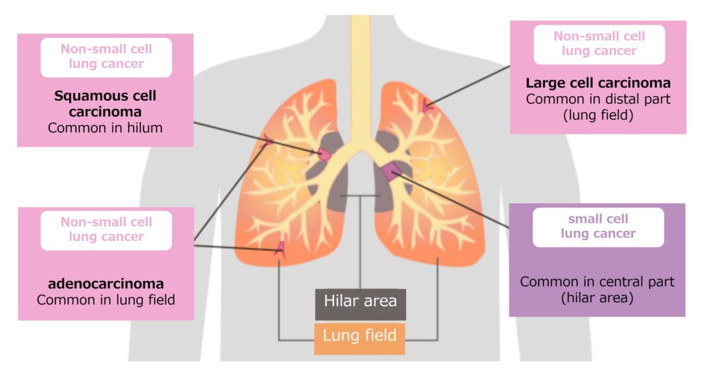 Small Cell Lung Cancer Therapeutics Market 2029: Untapped Opportunities and Growth Strategies Revealed